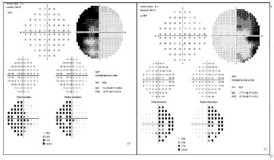 Spindle cell oncocytoma of the pituitary tumor: A rare case report and literature reviews